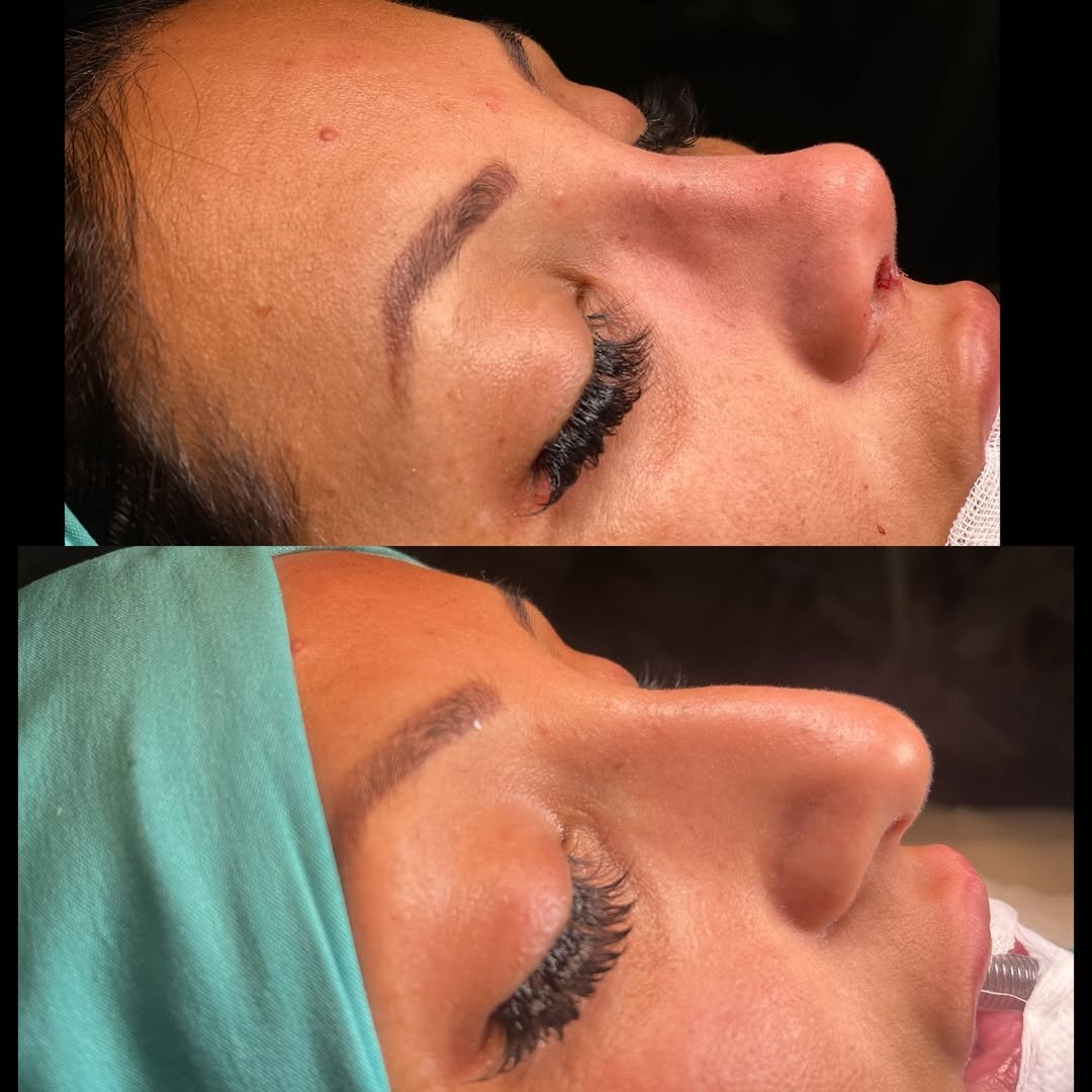 Tipplasty before and after — profile view