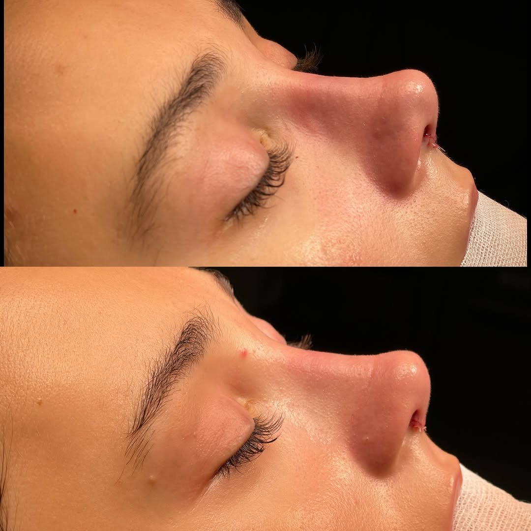 Tipplasty before and after — tip definition