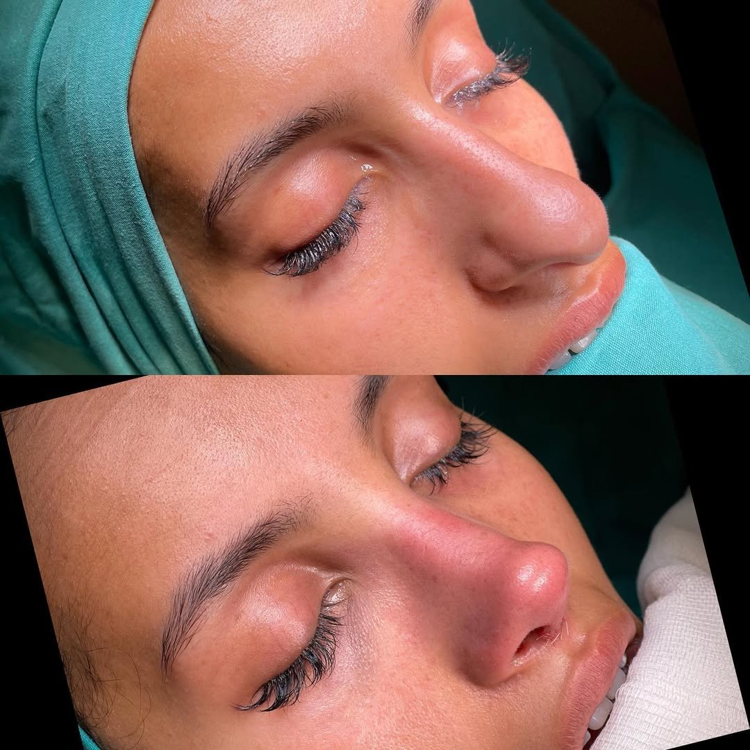Tipplasty before and after — drooping tip lifted