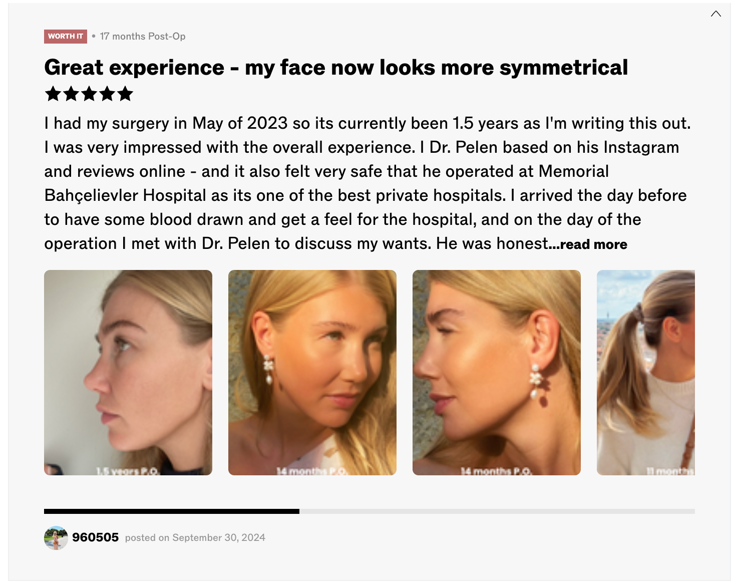 Patient rhinoplasty result — 17 months post-op