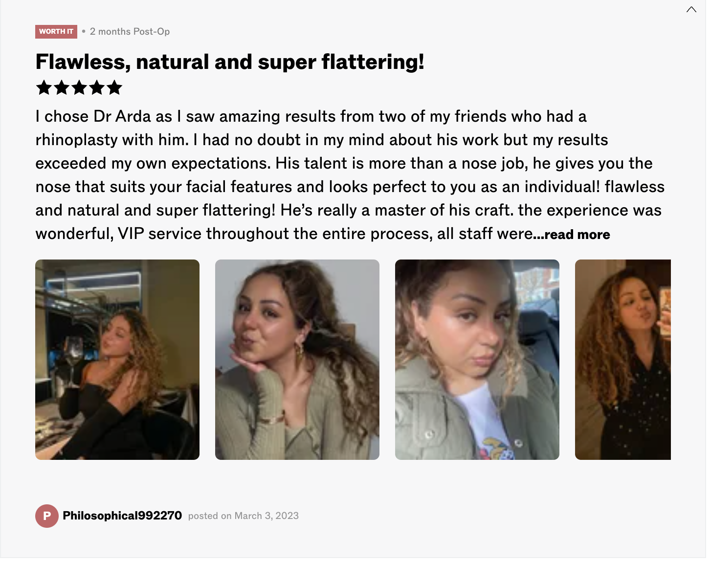 Patient rhinoplasty result — 2 months post-op