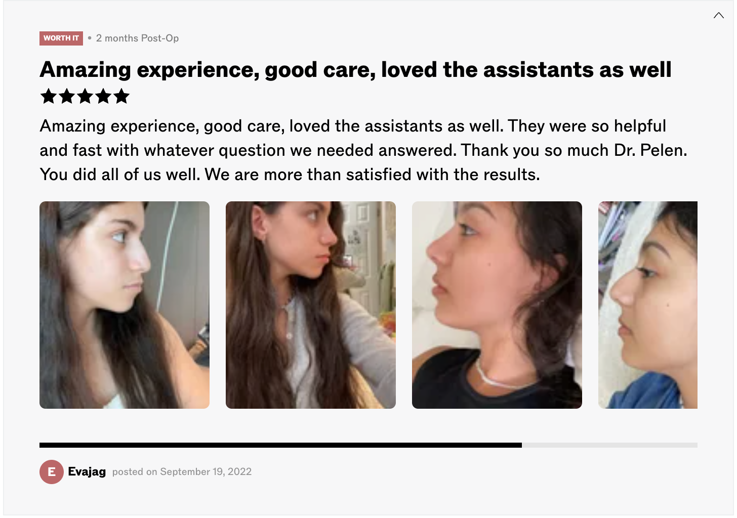 Patient rhinoplasty result — 2 months post-op
