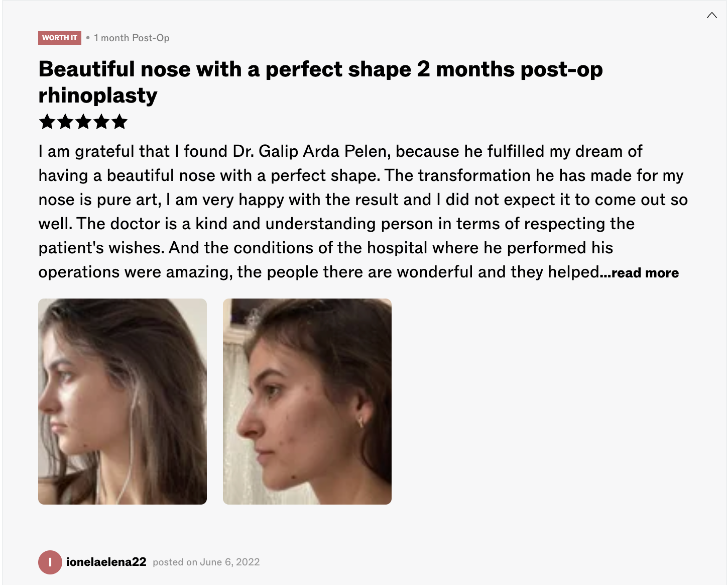 Patient rhinoplasty result — 1 month post-op