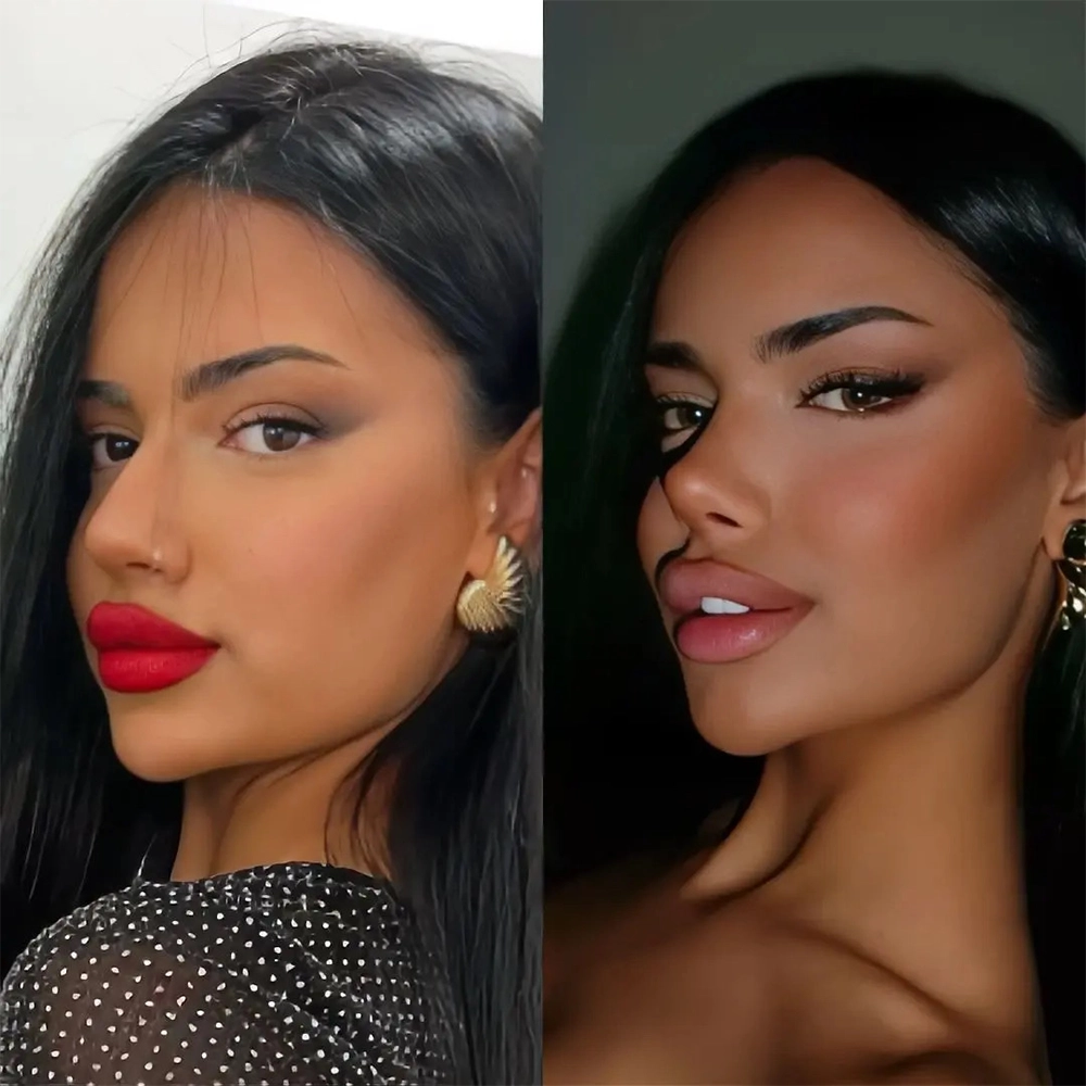 Rhinoplasty before and after — Op. Dr. G. Arda Pelen